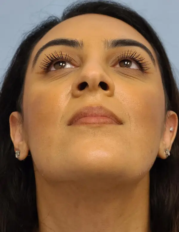 Rhinoplasty — after, base view — Dr. Faramarz Shabdiz, MD. Individual results vary.