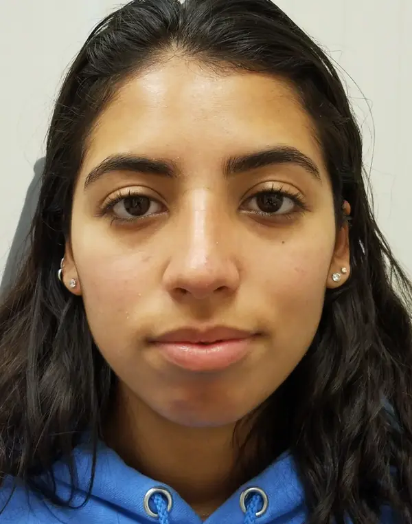 Rhinoplasty — after, front — Dr. Faramarz Shabdiz, MD. Individual results vary.