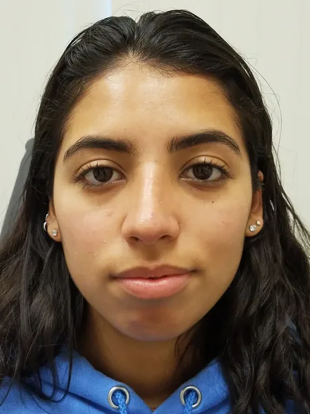 Additional Results — after photo, front view, Dr. Faramarz Shabdiz, MD, Orange County, CA. Individual results vary.