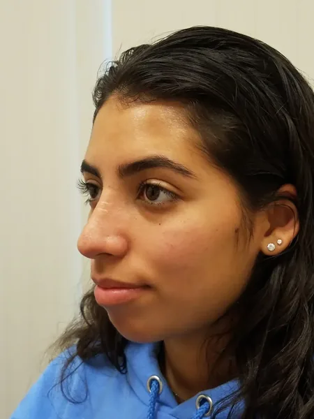 Additional Results — after photo, oblique view, Dr. Faramarz Shabdiz, MD, Orange County, CA. Individual results vary.