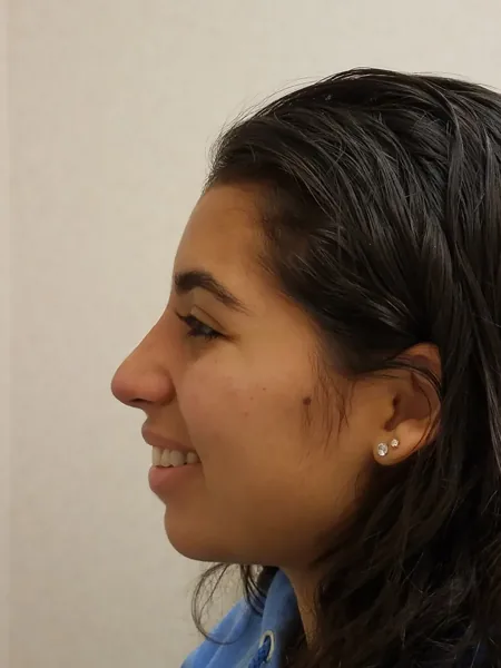 Additional Results — after photo, left profile, Dr. Faramarz Shabdiz, MD, Orange County, CA. Individual results vary.