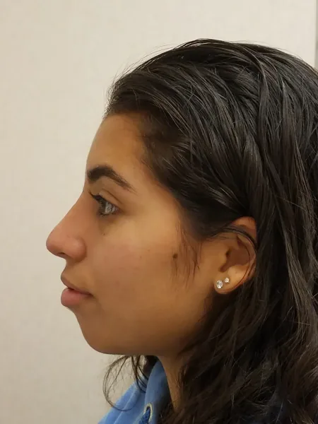 Rhinoplasty — after, left profile — Dr. Faramarz Shabdiz, MD. Individual results vary.