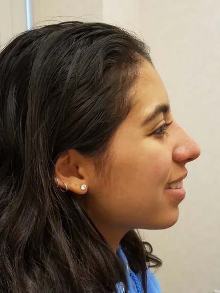 Additional Results — after photo, right profile, Dr. Faramarz Shabdiz, MD, Orange County, CA. Individual results vary.