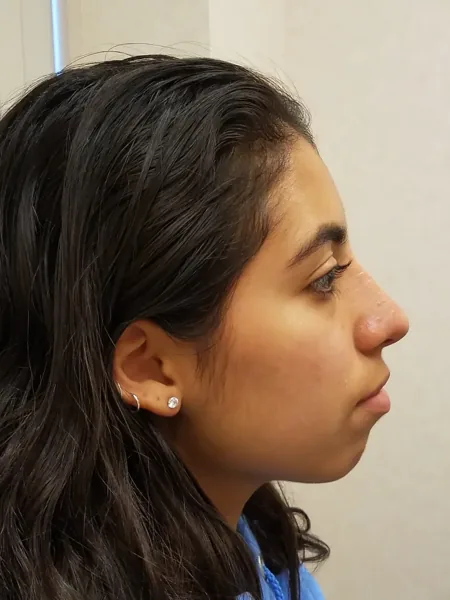 Rhinoplasty — after, right profile — Dr. Faramarz Shabdiz, MD. Individual results vary.
