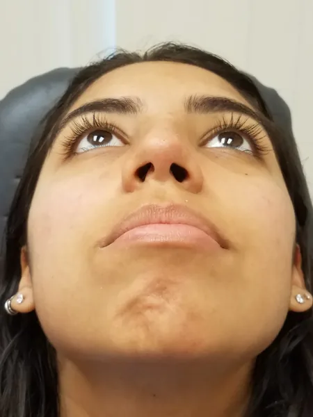 Additional Results — after photo, base view, Dr. Faramarz Shabdiz, MD, Orange County, CA. Individual results vary.