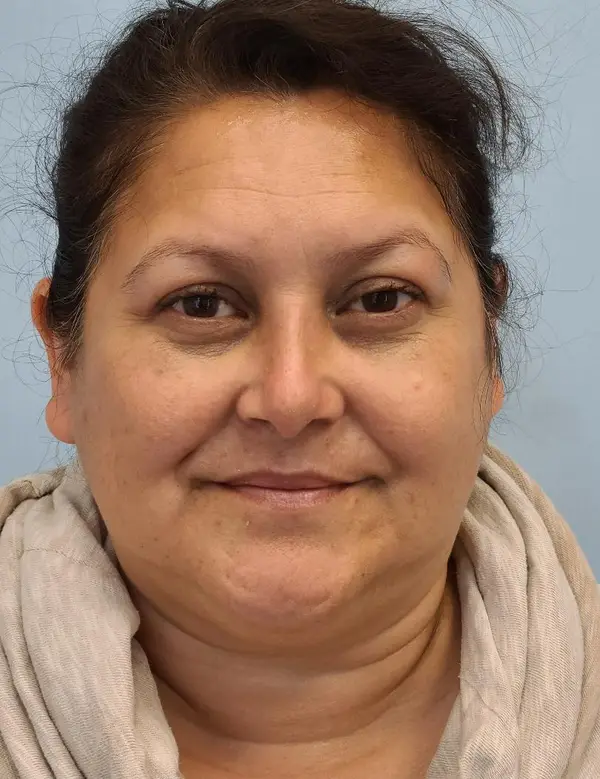 Rhinoplasty — after photo, front view, Dr. Faramarz Shabdiz, MD, Orange County, CA. Individual results vary.