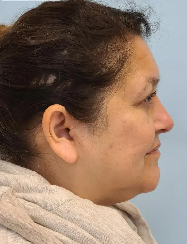 Rhinoplasty — after photo, right profile, Dr. Faramarz Shabdiz, MD, Orange County, CA. Individual results vary.