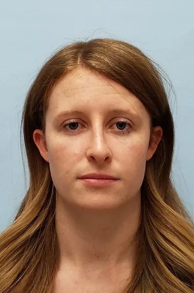 Additional Results — after photo, front view, Dr. Faramarz Shabdiz, MD, Orange County, CA. Individual results vary.