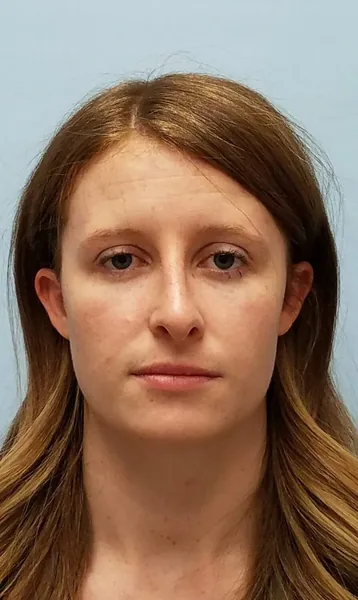 Additional Results — after photo, front view, Dr. Faramarz Shabdiz, MD, Orange County, CA. Individual results vary.