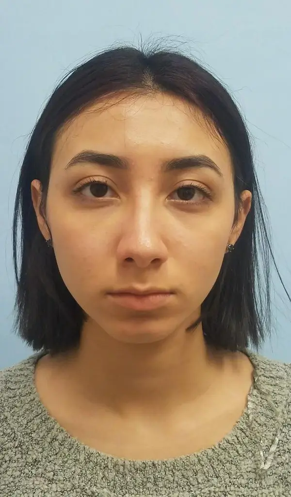 Rhinoplasty — after photo, front view, Dr. Faramarz Shabdiz, MD, Orange County, CA. Individual results vary.