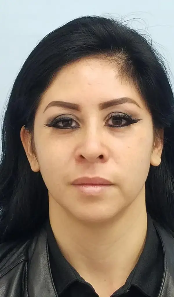 Rhinoplasty — after photo, front view, Dr. Faramarz Shabdiz, MD, Orange County, CA. Individual results vary.