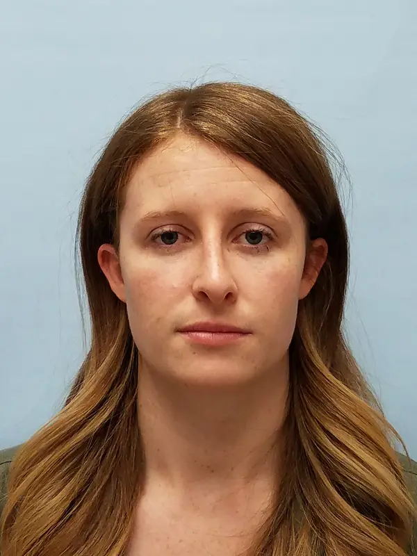 Rhinoplasty — after photo, front view, Dr. Faramarz Shabdiz, MD, Orange County, CA. Individual results vary.