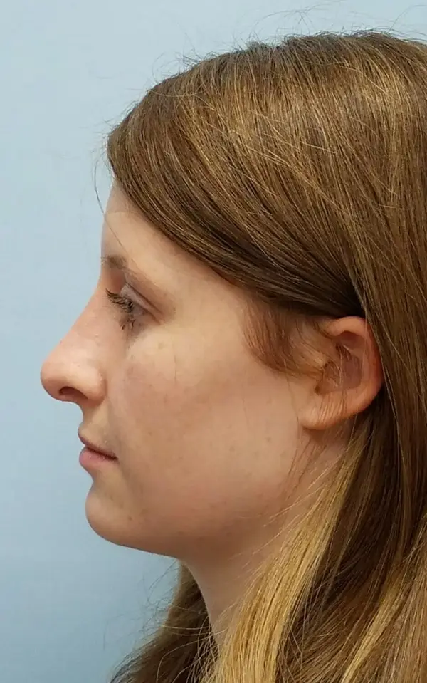 Rhinoplasty — after, left profile — Dr. Faramarz Shabdiz, MD. Individual results vary.