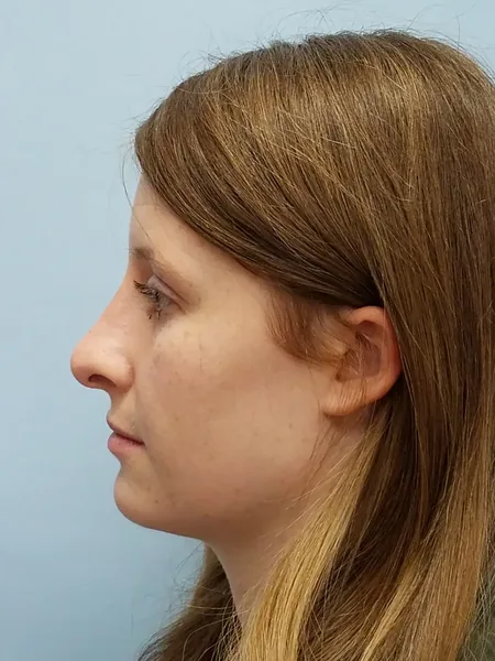 Additional Results — after photo, left profile, Dr. Faramarz Shabdiz, MD, Orange County, CA. Individual results vary.