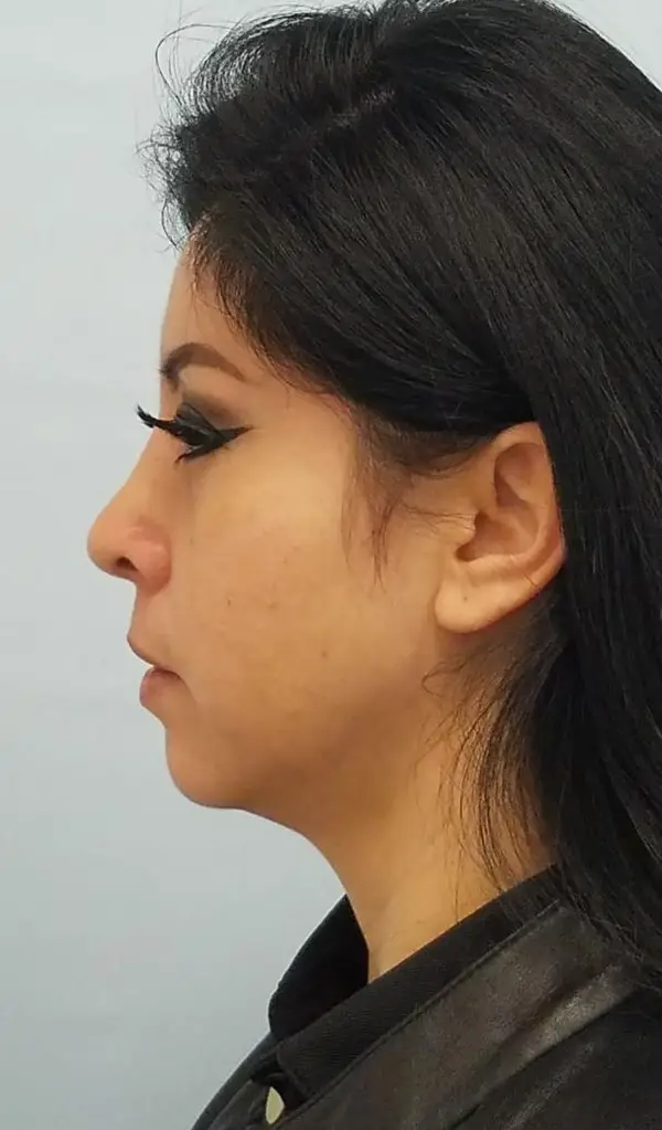 Rhinoplasty — after, left profile — Dr. Faramarz Shabdiz, MD. Individual results vary.