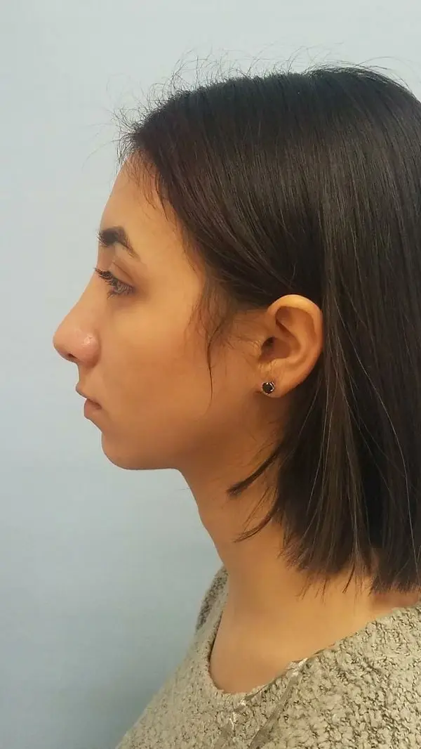 Rhinoplasty — after photo, left profile, Dr. Faramarz Shabdiz, MD, Orange County, CA. Individual results vary.