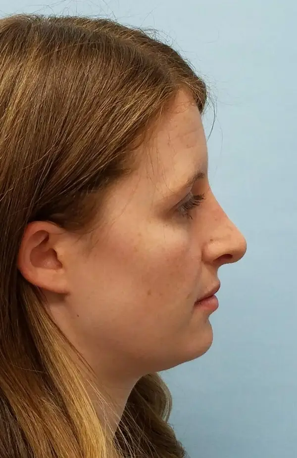 Rhinoplasty — after, right profile — Dr. Faramarz Shabdiz, MD. Individual results vary.
