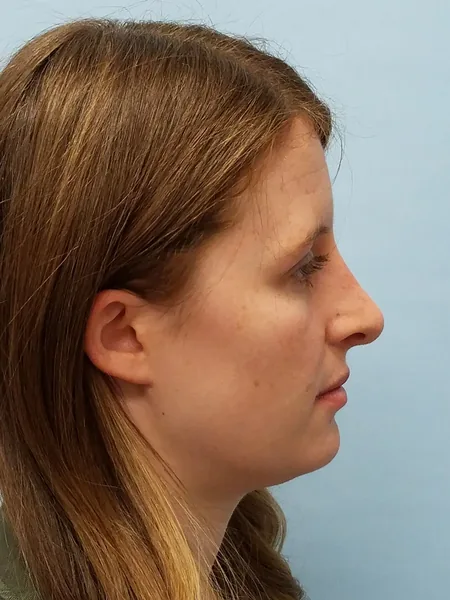 Additional Results — after photo, right profile, Dr. Faramarz Shabdiz, MD, Orange County, CA. Individual results vary.