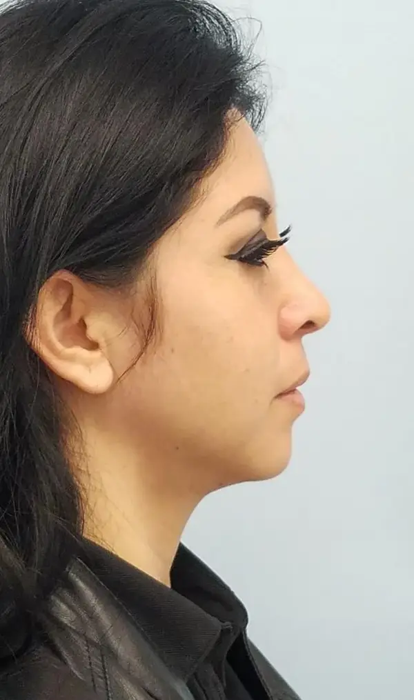 Rhinoplasty — after, right profile — Dr. Faramarz Shabdiz, MD. Individual results vary.