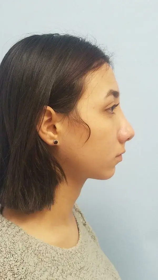 Rhinoplasty — after photo, right profile, Dr. Faramarz Shabdiz, MD, Orange County, CA. Individual results vary.