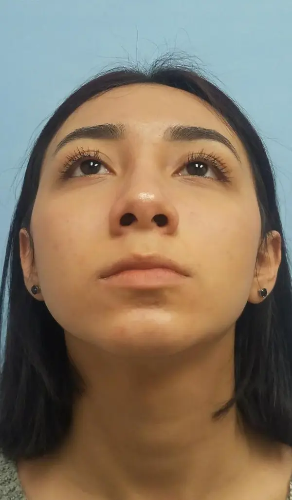 Rhinoplasty — after photo, base view, Dr. Faramarz Shabdiz, MD, Orange County, CA. Individual results vary.