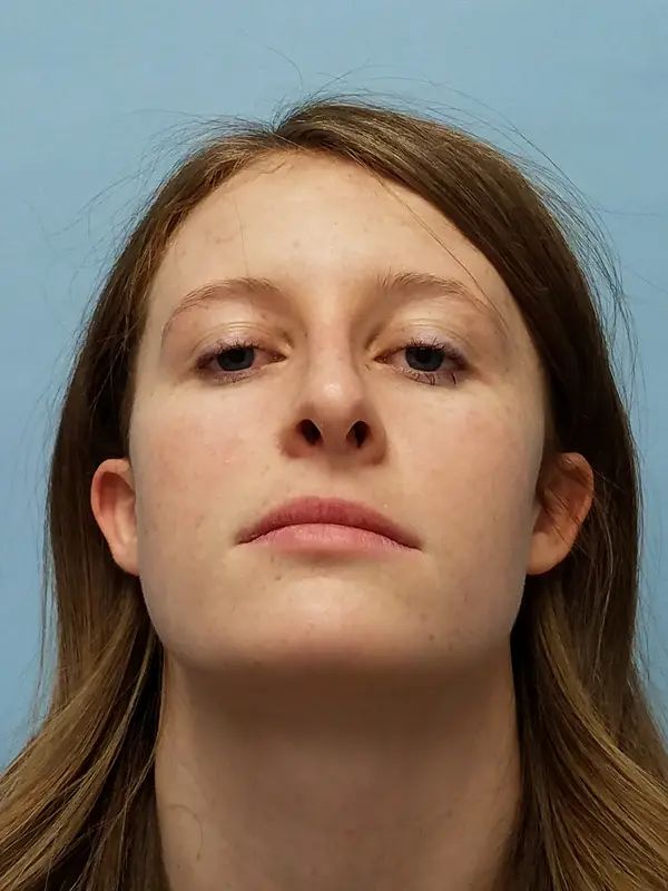 Rhinoplasty — after, base view — Dr. Faramarz Shabdiz, MD. Individual results vary.