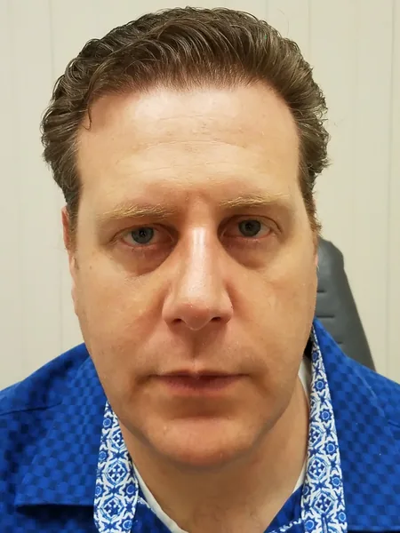 Rhinoplasty — after, front — Dr. Faramarz Shabdiz, MD. Individual results vary.