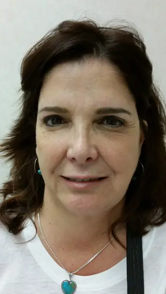 Rhinoplasty — after, front — Dr. Faramarz Shabdiz, MD. Individual results vary.