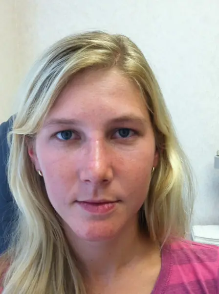 Rhinoplasty — after, front — Dr. Faramarz Shabdiz, MD. Individual results vary.