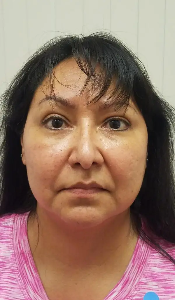 Rhinoplasty — after photo, front view, Dr. Faramarz Shabdiz, MD, Orange County, CA. Individual results vary.