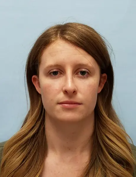 Rhinoplasty — after, front — Dr. Faramarz Shabdiz, MD. Individual results vary.