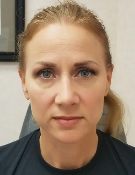 Rhinoplasty — after, front — Dr. Faramarz Shabdiz, MD. Individual results vary.