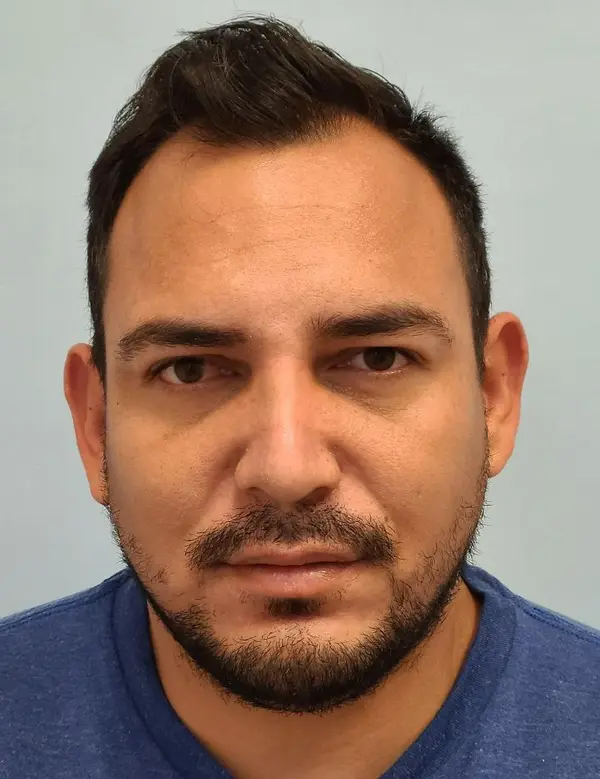 Rhinoplasty — after photo, front view, Dr. Faramarz Shabdiz, MD, Orange County, CA. Individual results vary.