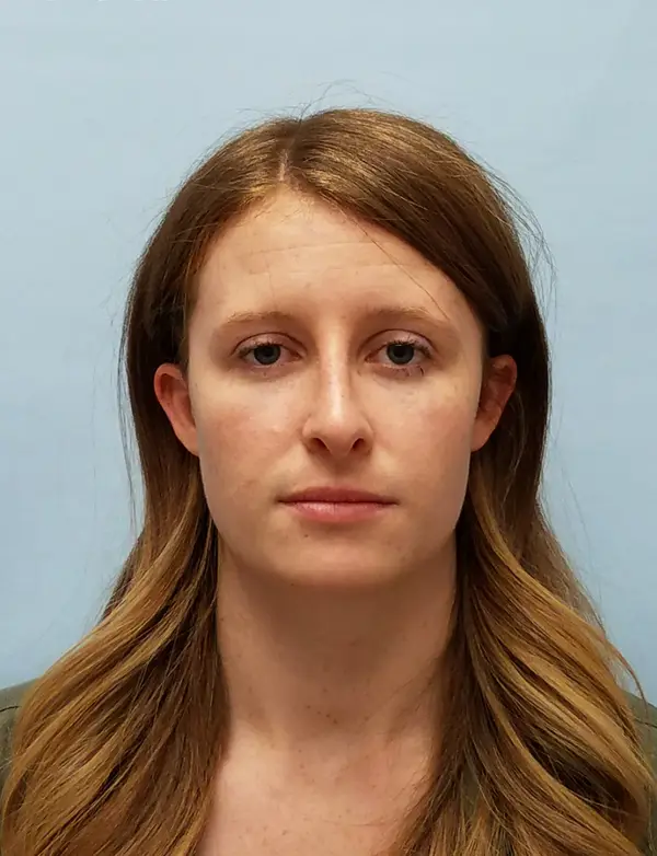 Rhinoplasty — after photo, front view, Dr. Faramarz Shabdiz, MD, Orange County, CA. Individual results vary.