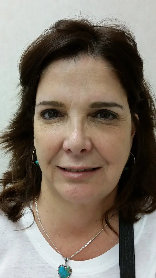 Consented standalone clinical photograph, file postop-face; not a verified comparison