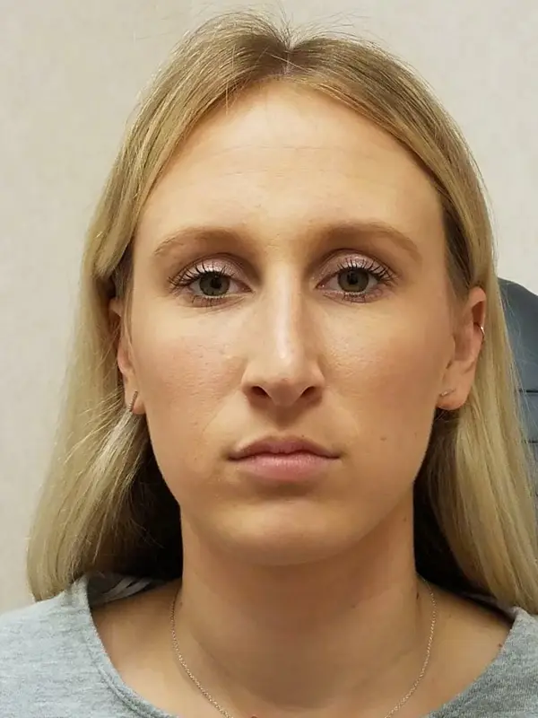 Rhinoplasty — after, front — Dr. Faramarz Shabdiz, MD. Individual results vary.