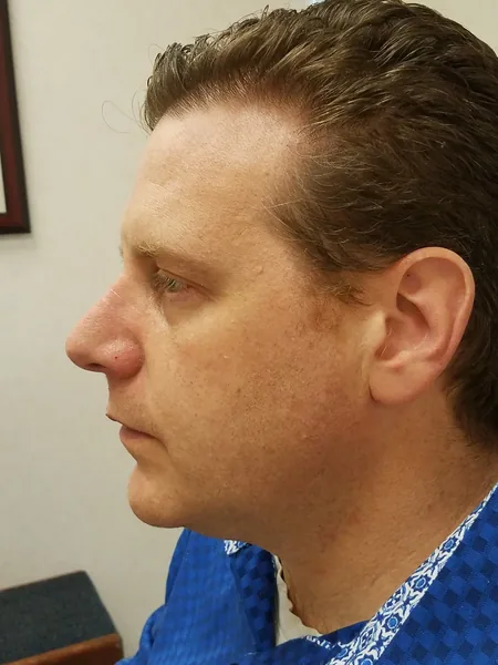 Additional Results — after photo, left profile, Dr. Faramarz Shabdiz, MD, Orange County, CA. Individual results vary.