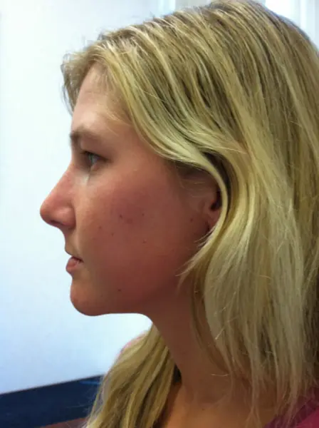 Rhinoplasty — after, left profile — Dr. Faramarz Shabdiz, MD. Individual results vary.