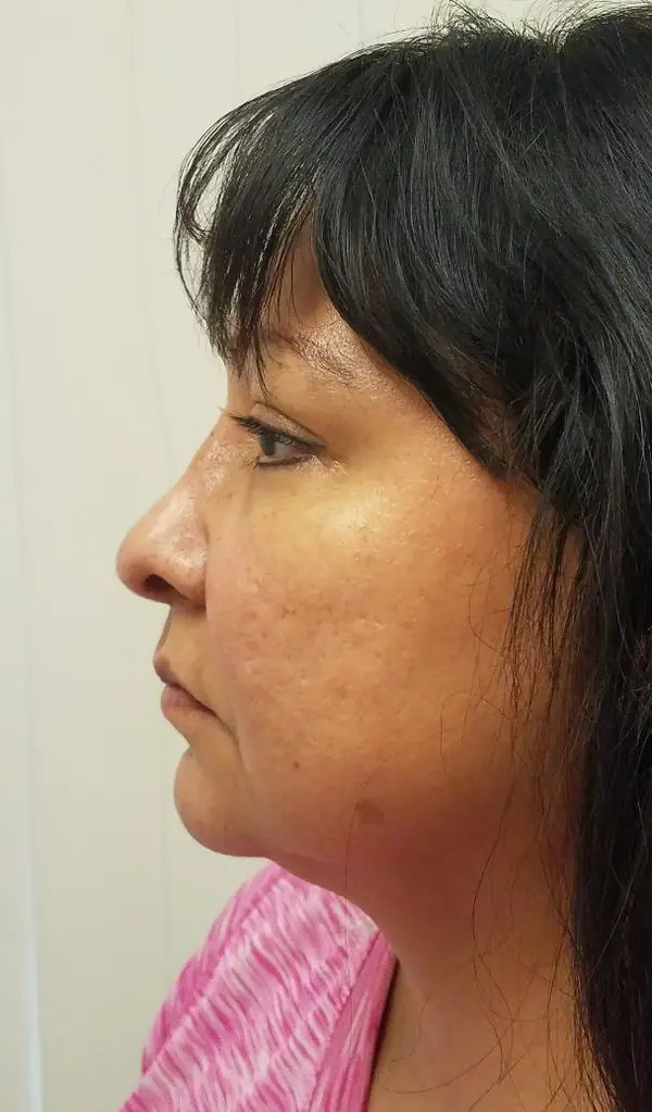Rhinoplasty — after photo, left profile, Dr. Faramarz Shabdiz, MD, Orange County, CA. Individual results vary.
