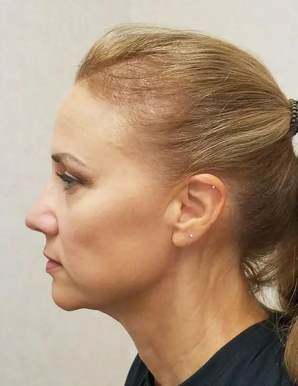 Rhinoplasty — after, left profile — Dr. Faramarz Shabdiz, MD. Individual results vary.