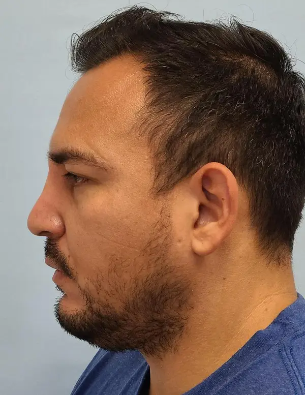 Rhinoplasty — after photo, left profile, Dr. Faramarz Shabdiz, MD, Orange County, CA. Individual results vary.