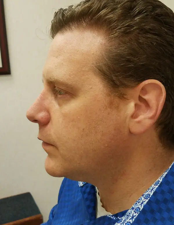 Rhinoplasty — after, left profile — Dr. Faramarz Shabdiz, MD. Individual results vary.