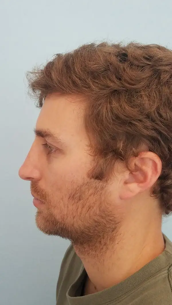 Rhinoplasty — after, left profile — Dr. Faramarz Shabdiz, MD. Individual results vary.