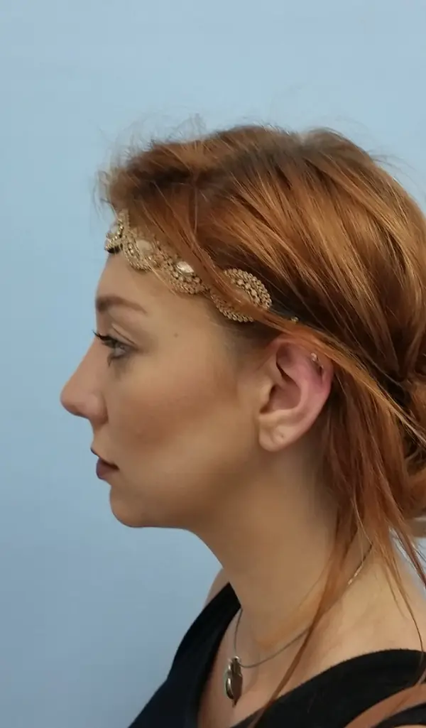 Rhinoplasty — after, left profile — Dr. Faramarz Shabdiz, MD. Individual results vary.