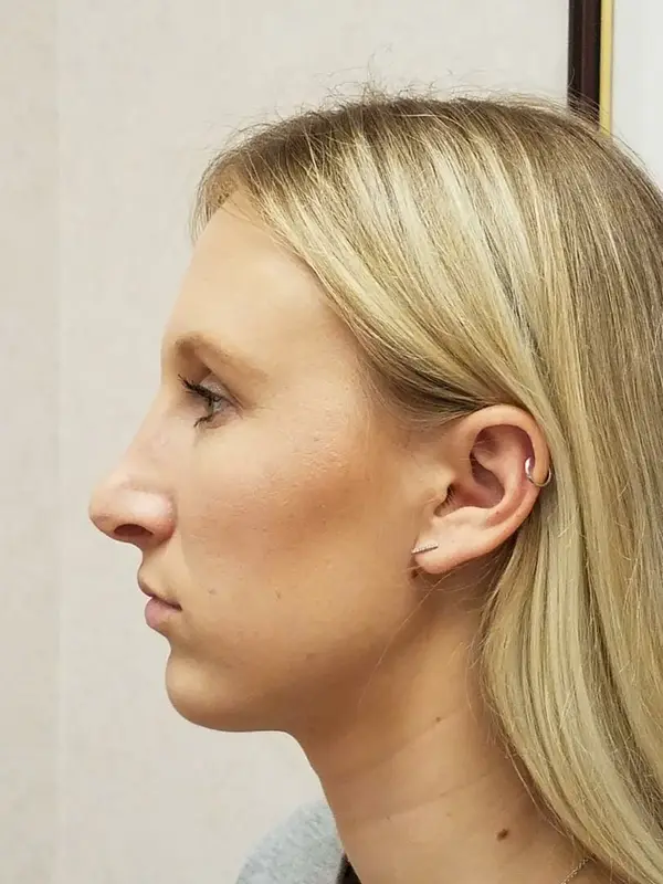 Rhinoplasty — after, left profile — Dr. Faramarz Shabdiz, MD. Individual results vary.