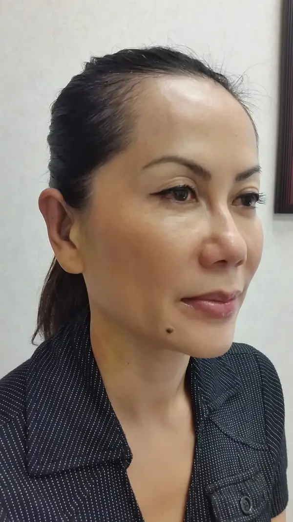 Otoplasty (ear surgery) — after, oblique view — Dr. Faramarz Shabdiz, MD. Individual results vary.