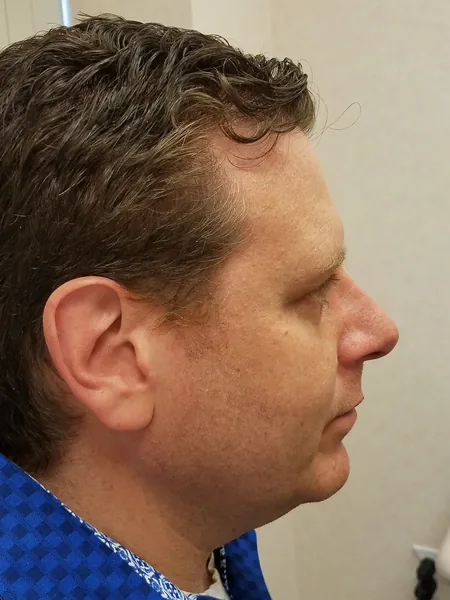 Additional Results — after photo, right profile, Dr. Faramarz Shabdiz, MD, Orange County, CA. Individual results vary.