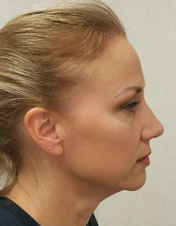Rhinoplasty — after, right profile — Dr. Faramarz Shabdiz, MD. Individual results vary.
