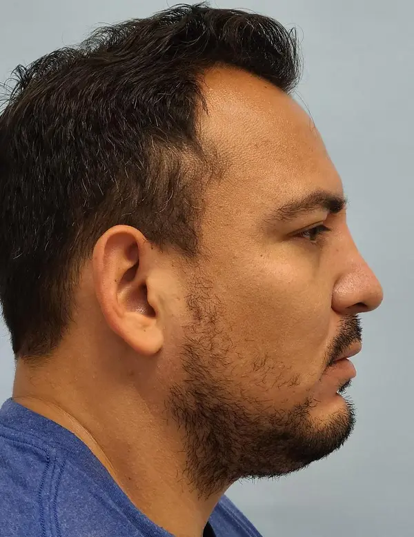 Rhinoplasty — after photo, right profile, Dr. Faramarz Shabdiz, MD, Orange County, CA. Individual results vary.