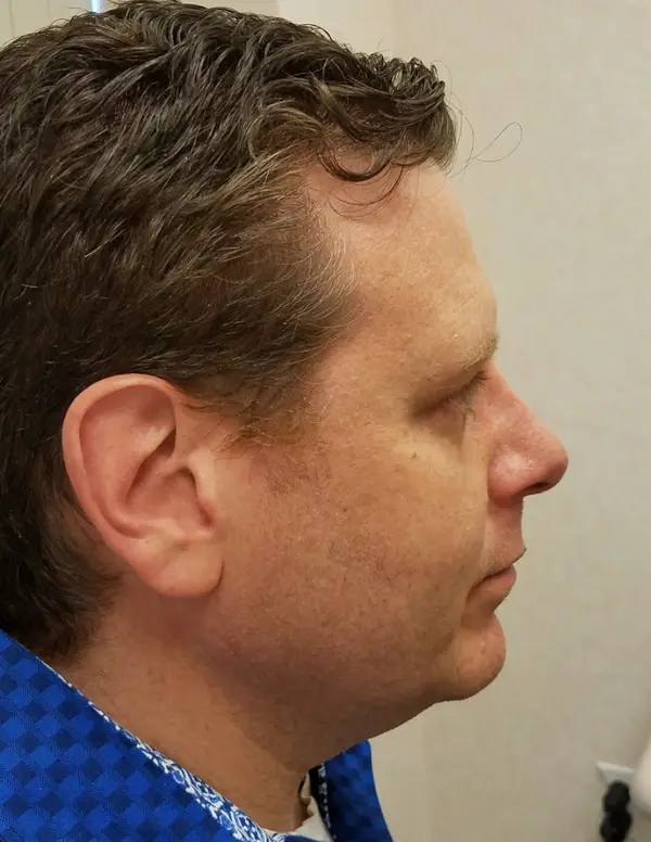 Rhinoplasty — after, right profile — Dr. Faramarz Shabdiz, MD. Individual results vary.